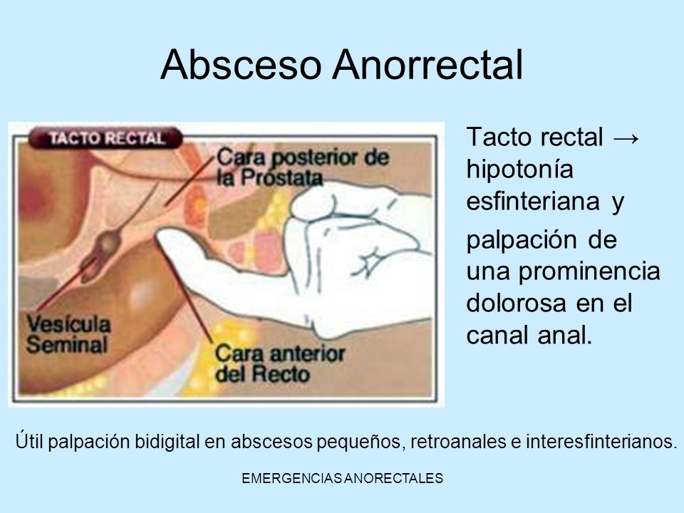 absceso anorrectal